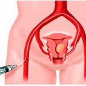 Eliminarea fibrom uterin - Efecte