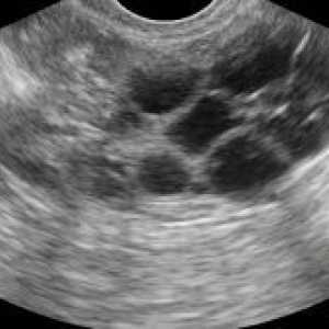 Ultrasunete ovarian