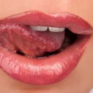 Inflamație a limbii