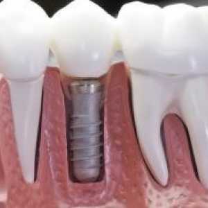 Implanturile dentare - „pentru“ și „contra“